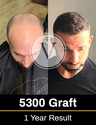 5300 Graft Hair Transplant Result after 1 year