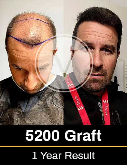 5200 Graft Hair Transplant Result after 1 year