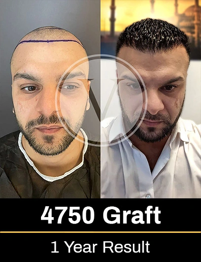 4750 Graft Hair Transplant Result after 1 year