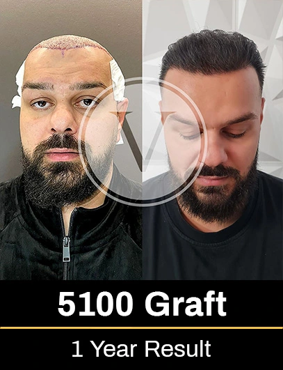 5100 Graft Hair Transplant Result after 1 year