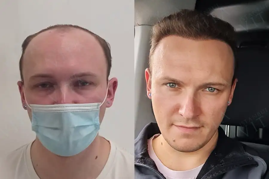 Через 1 год после операции по волос
